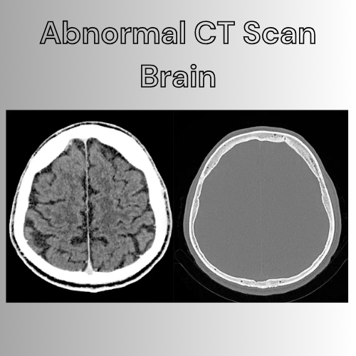 Abnormal CT Scan Brain