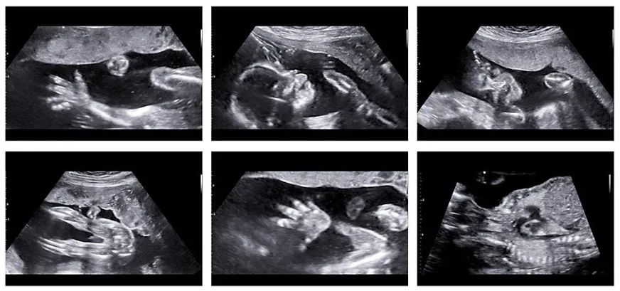 5th Month TIFFA scan Images